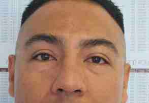Male Eyelid Surgery Before & After Patient #9688
