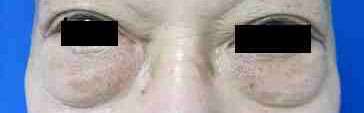 Male Eyelid Surgery Before & After Patient #9694
