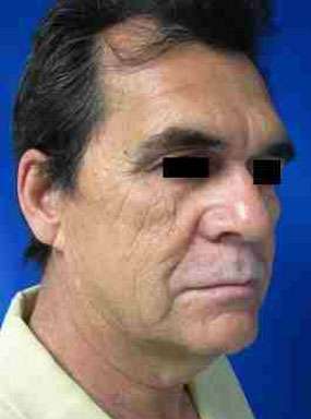 Male Face and Neck Lift Before & After Patient #9699