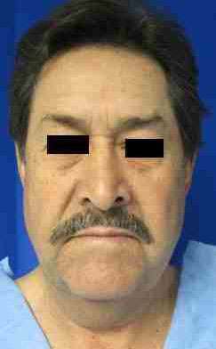 Male Face and Neck Lift Before & After Patient #9704