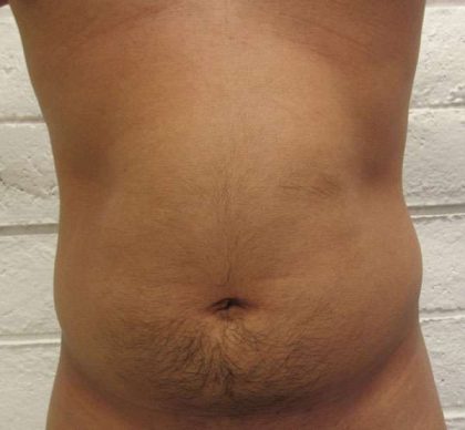 Male Liposuction Before & After Patient #9712