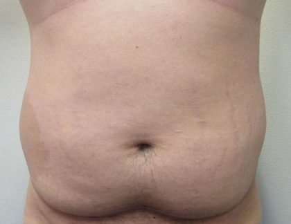 Male Liposuction Before & After Patient #9715