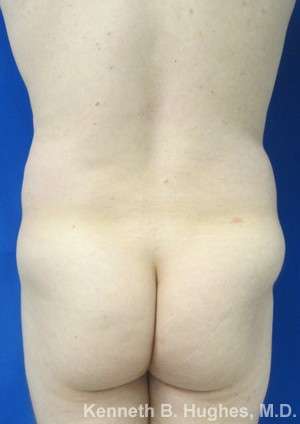 Male Liposuction Before & After Patient #9734