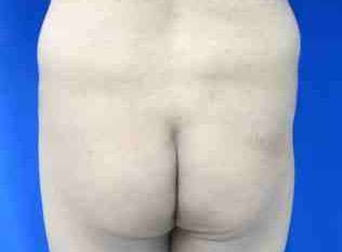 Male Liposuction Before & After Patient #9740