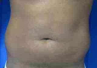 Male Liposuction Before & After Patient #9745
