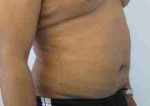 Male Liposuction Before & After Patient #9748