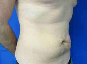 Male Liposuction Before & After Patient #9754