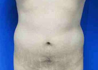 Male Liposuction Before & After Patient #9757