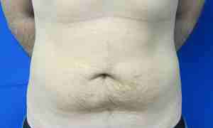Male Liposuction Before & After Patient #9763