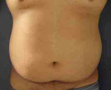 Male Liposuction Before & After Patient #9769