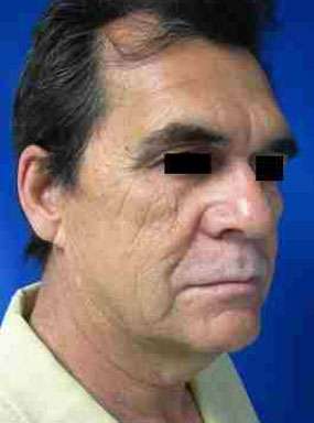 Male Neck Lift Before & After Patient #9774