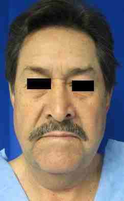 Male Neck Lift Before & After Patient #9779