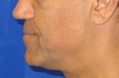 Male Neck Lift Before & After Patient #9782