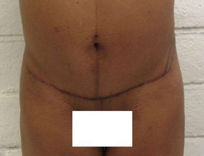 Brazilian Butt Lift Before & After Patient #6291