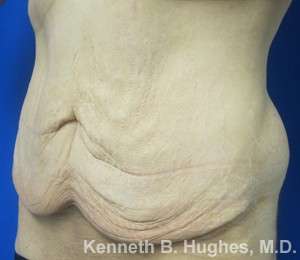 Male Tummy Tuck Before & After Patient #9785