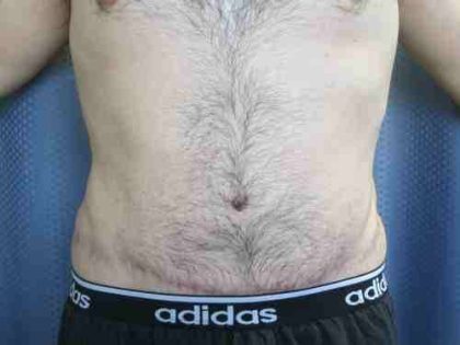 Male Tummy Tuck Before & After Patient #9791
