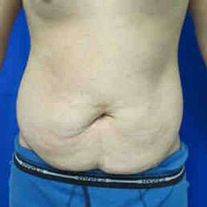 Male Tummy Tuck Before & After Patient #9794