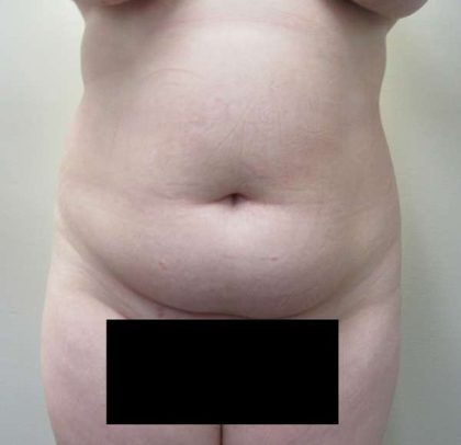 Mommy Makeover Before & After Patient #9797