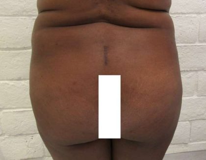 Brazilian Butt Lift Before & After Patient #6294