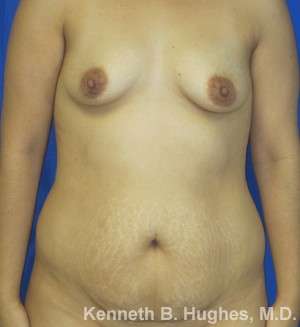 Mommy Makeover Before & After Patient #9827