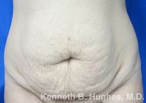 Mommy Makeover Before & After Patient #9837