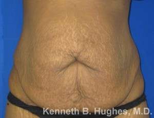 Mommy Makeover Before & After Patient #9840