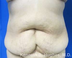 Mommy Makeover Before & After Patient #9843