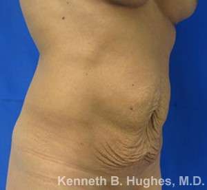 Mommy Makeover Before & After Patient #9848