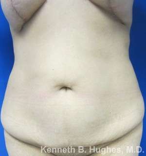Mommy Makeover Before & After Patient #9854