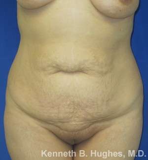 Mommy Makeover Before & After Patient #9857