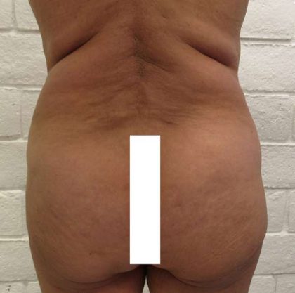 Brazilian Butt Lift Before & After Patient #6297