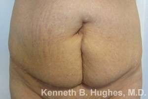 Mommy Makeover Before & After Patient #9869