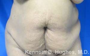 Mommy Makeover Before & After Patient #9872