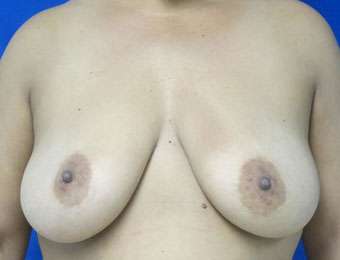 Mommy Makeover Before & After Patient #9897