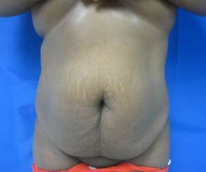 Mommy Makeover Before & After Patient #9905