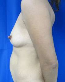 Mommy Makeover Before & After Patient #9908