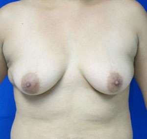 Mommy Makeover Before & After Patient #9914