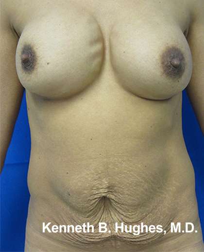 Mommy Makeover Before & After Patient #9917