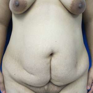 Mommy Makeover Before & After Patient #9920