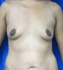 Mommy Makeover Before & After Patient #9923