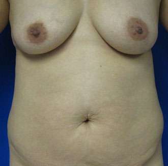 Mommy Makeover Before & After Patient #9926