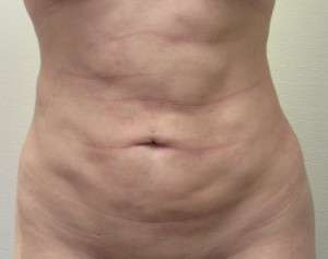 Abdomen Before & After Patient #5880