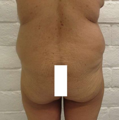 Brazilian Butt Lift Before & After Patient #6304