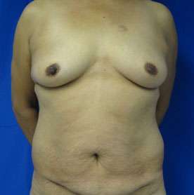 Mommy Makeover Before & After Patient #9929