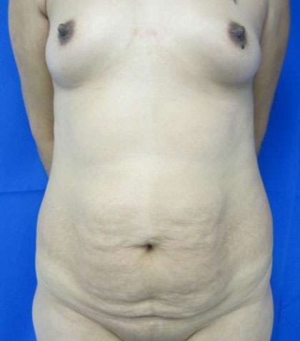Mommy Makeover Before & After Patient #9932