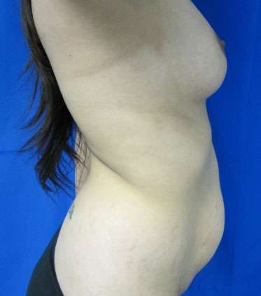 Mommy Makeover Before & After Patient #9935
