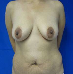 Mommy Makeover Before & After Patient #9938