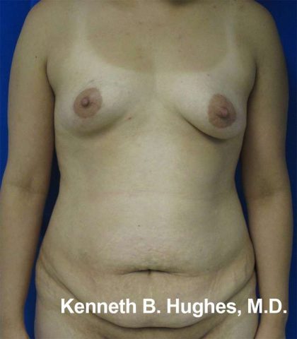 Mommy Makeover Before & After Patient #9941