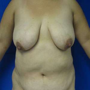 Mommy Makeover Before & After Patient #9947