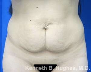 Mommy Makeover Before & After Patient #9957